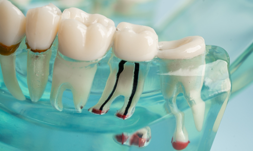 root canal aftercare tips for recovery