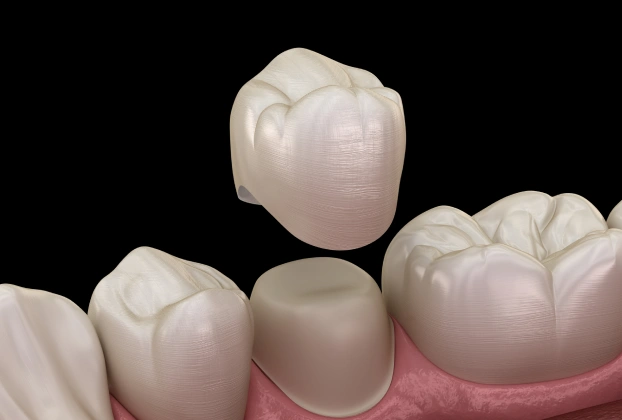 Dental Crowns